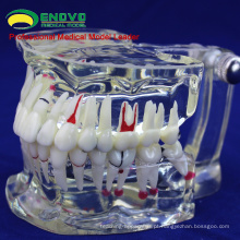 VENDER 12568 Dentes Dentais Adultos Transparente Disase Modelo Mostrar Cárie